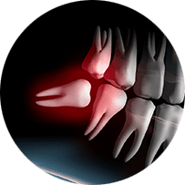 親知らずの抜歯